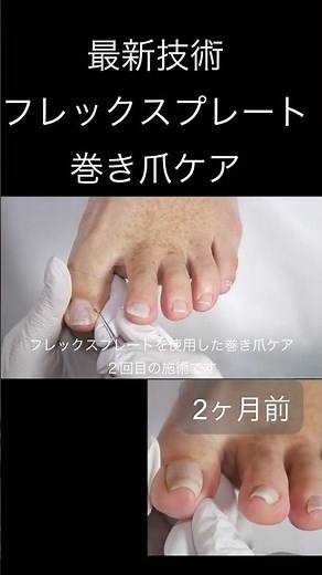 巻き爪ケア前のカウンセリング ご自宅での爪の切り方について