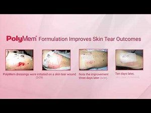 PolyMem Formulation Improves Skin Tear Outcomes