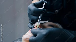 lip augmentation procedure. close-up, female lips. Male surgeon injectionist carefully and slowly injects hyaluronic acid into woman's lips with a syringe. beauty injections. Plastic surgery.
