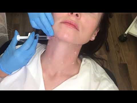 Profhilo Neck. Transform Your Neck with Profhilo: Expert Treatment by Sharon at Mi Skin Clinic!