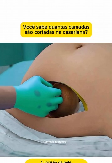 7 Camadas Cortadas na Cesariana: Você Sabia?