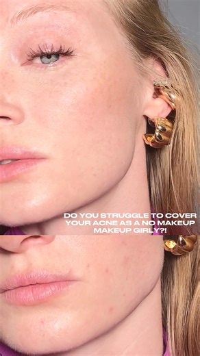Ash Walker | How I cover acne as a no makeup makeup girly! Covering acne can be so hard! I used to think I had to apply heavy foundation to cover my... | Instagram