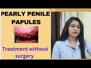 Pearly penile papules treatment without surgery !! Pearly penile papules symptoms,causes & medicine