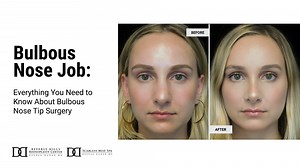 Getting a bulbous nose job | Scarless Med Spa by Deepak Dugar M.D
