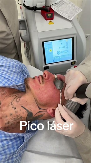 Así actúa el láser de picosegundos en la piel