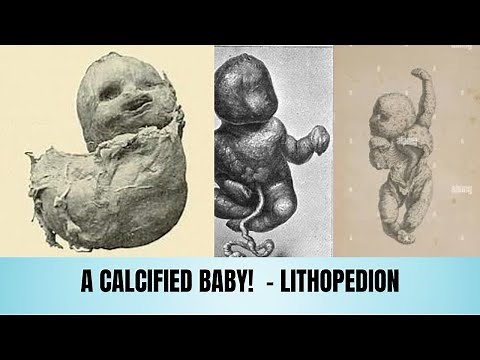 The Stone Baby Phenomenon Lithopedion