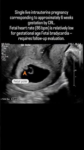 Fetal bradycardia