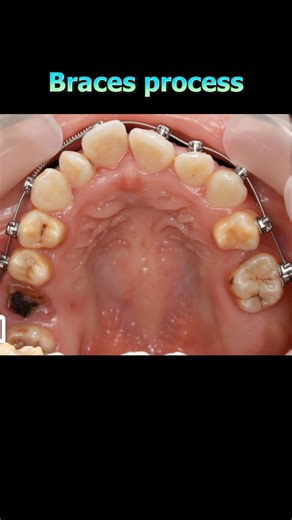 Braces process: Fix crooked teeth to straighten teeth #braces #orthodontist #dentist #orthodontics