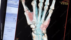 Pictures of the bone scan on the monitor.