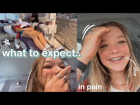 I got braces... (what to expect in the first couple days)