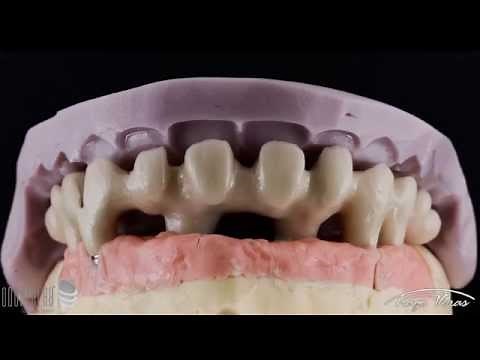 Prótese sobre implante - Protocolo cerâmico (técnica, procedimentos e resultado)
