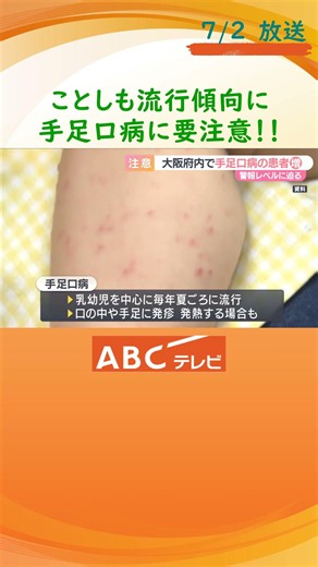 大阪で手足口病の患者増加 警戒レベルに迫る、府が注意呼びかけ 乳幼児を中心に毎年夏ごろ流行
