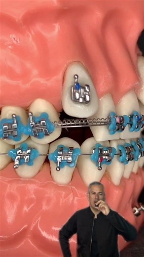 🔥Combining Forces with ORTHODONTIC Brackets🔥