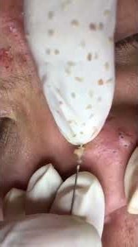 Deep Blackhead Removal From Nose — So Satisfying! 😳