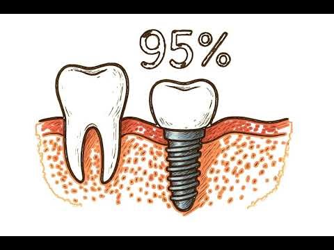 Root Canal Alternatives Explained | Cedar Dental Group | Renton, WA