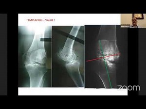 Principles of Total Knee Arthroplasty - Dr SKS Smarya