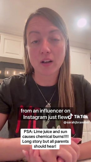 Chemical Burns from Lime Juice Exposure