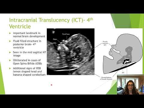 Beyond the ‘Nuchal’- Getting the Most from the 11-14 Week Ultrasound | Michelle Sutherland | AFIC