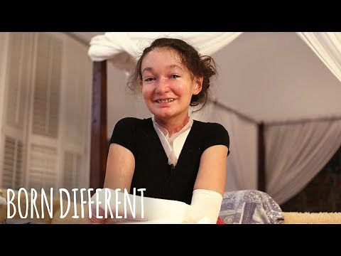 The Teenager With Butterfly Skin | BORN DIFFERENT