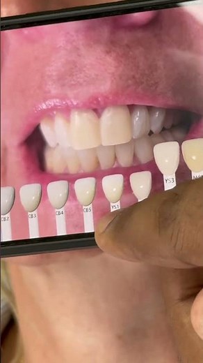 Digital shade guide!