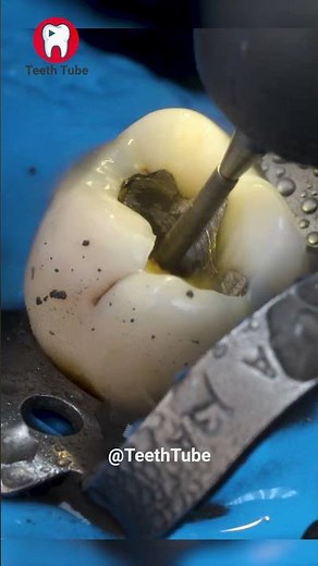 AMAZING Silver Filling Removal ASMR 4k #shorts #asmr