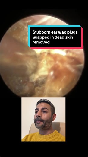 Stubborn ear wax plugs wrapped in dead skin removed using the iCLEARscope®. Safely cleared with endoscopic vision. Performed by Consultant Audiologist Mr Neel Raithatha at The Hear Clinic. #earwax #earwaxremoval #blockedear #endoscopic #medical