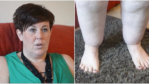 Lipoedema means Claire Tickle's legs weigh 60 kilos