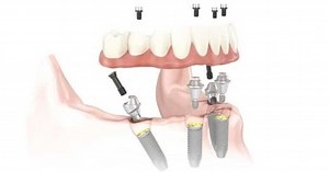 Teeth in a Day Dental Implants: Procedure, Cost, Reviews - Dentaly.org