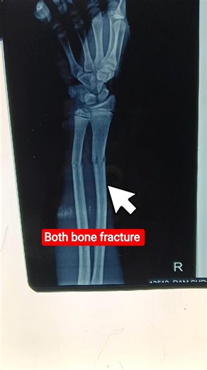 X ray of Both bone fracture of Right forearm #medicosfactz #healthawareness
