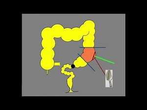 On table lavage of left colon cancer obstruction