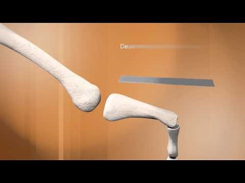 L'ostéotomie de Weil des métatarsiens latéraux - Dr. Coillard | Dr. Boublil | Dr. Grisard -