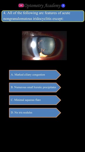 5K views · 49 reactions | Acute nongranulomatous iridocyclitis | Optometry Academy | Facebook
