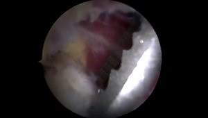 Arthroscopic Latarjet Using A Cortical Button: The Arthroscopic Step by Step