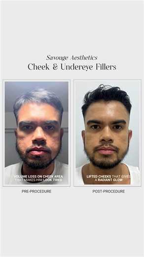 5.1K views | Feeling like the male version of Maleficent with those sunken under-eyes and cheeks? Gents! Don’t let these imperfections make you look tired and older. Our doctors use dermal fillers to enhance men's facial features, just like Gab's. Watch his full transformation on our YouTube segment, Savouge Unfiltered, "Episode 2: Looking More Masculine." Link in the comments. #undereyefiller #e#eyefillet #cheeks | Savouge Aesthetics BGC Premier | Facebook