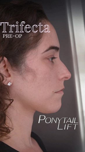 Ponytail Lift And The Trifecta of Beauty: Pre-Op - She’s concerned about her face dropping as shes aged, and her eyebrows have dropped. She’s also lost volume in her face due to weight loss. We’ll be using a combination of procedures to address her concerns: Ponytail Lift KaoEyes Rhinoplasty = Trifecta of Beautification. Now the brows, eyes, cheeks, and nose can be shaped snd beautified without the visible incisions and scars. Let me know what you think in the comments! #PonytailLift #beautifica