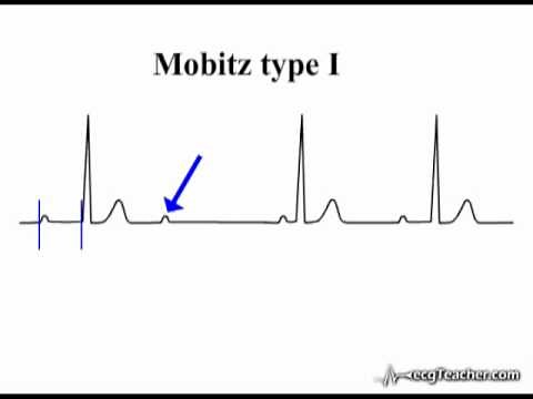 ECG Interpretation - Atrio-Ventricular Block
