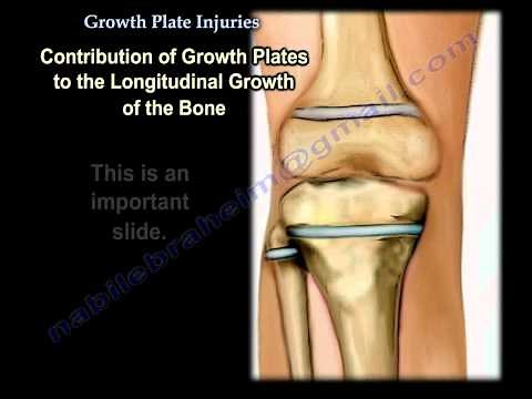 Growth Plate Injuries ,Overview- Everything You Need To Know - Dr. Nabil Ebraheim