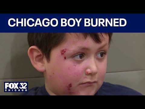 Suburban Chicago boy burned after NeeDoh toy explodes in microwave