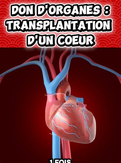 #medecine #chirurgie ##operation #apprendre Une transplantation cardiaque est une course contre la montre qui commence par ce qu'on appelle l'ischémie froide. ​Dès que le cœur est prélevé, il est plongé dans une solution de conservation à 4°C pour arrêter son métabolisme. ​Le chirurgien dispose alors de 4 à 6 heures maximum pour le réimplanter avant que les cellules ne meurent. ​L'opération commence par une sternotomie pour ouvrir la poitrine du receveur. ​On met en place une circulation extra-c