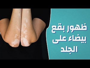 ظهور بقع بيضاء على الجلد #موضوع