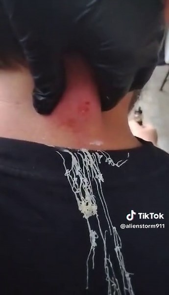 best neck pimple pop. thanks bro lmao #sillystring #fyp #pop #popgoestheweasel #pimple