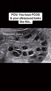 Polycystic ovaries are one of the most common symptoms of PCOS. And, due to the name PCOS, probably the symptom most often thought of when PCOS is discussed. But it is important to note that these are two different things / PCOS and PCO are not one in the same.. Polycystic ovaries are a finding on an ultrasound as seen in the video. Whereas PCOS is a complex metabolic & hormonal condition. Important facts to understand: ➡️ You can have polycystic ovaries on ultrasound and NOT have PCOS ➡️ You ca