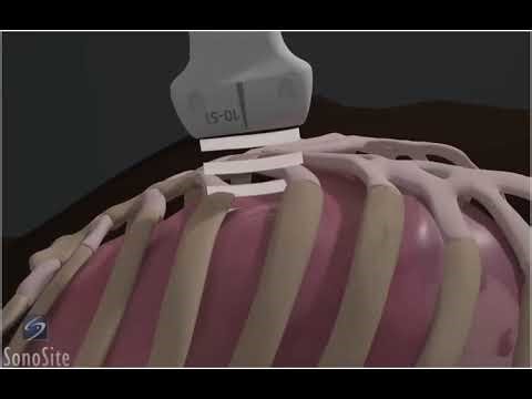 5. How To Lung Sliding Detection with Linear Transducer 3D Video _ Sonosite.