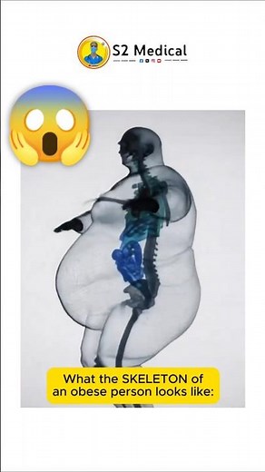 what the skeleton of an obese person look like #medical #shorts