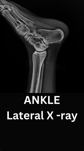 Dr Sameer Shelavale (MBBS,MS) on Instagram: "This is how I read an ankle X-ray in my OPD. Before looking for fractures, it’s important to know what normal looks like. The lateral view helps understand alignment, joint relationships, and depth things an AP view can miss. #AnkleXray #XrayInterpretation #Orthopaedics #Radiology #Physiotherapy @googleindia @apple @instagram normal ankle X-ray X-ray interpretation orthopaedics OPD radiology basics"