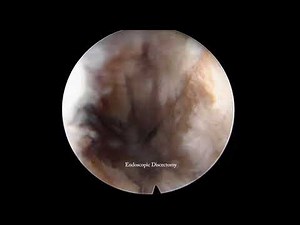 L5-S1 endoscopic lumbar interbody fusion