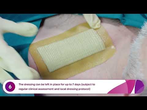 How to Apply and Remove Aquacel® Ag Surgical Dressings (Pacemaker)