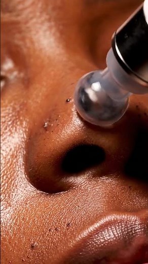 “Extreme Nose Clean Up! Suction ASMR 😳🔍✨