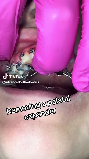 Is Expander Removal Painful? Find out Here!