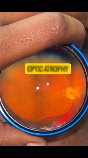 Dr. Lakshmi on Instagram: "WHAT IS OPTIC ATROPHY???? Death of retinal ganglion cell axons resulting in a pale optic disc and reduced visual function. CAUSES can be remembered as #VINDIT: •Vascular – AION, CRAO, CRVO •Inflammatory – Optic neuritis •Neoplastic / Compressive – Pituitary adenoma, meningioma •Degenerative / Demyelinating – Multiple sclerosis •Infective – TB, syphilis •Toxic / Nutritional – Methanol, ethambutol, tobacco–alcohol amblyopia •Traumatic – Head injury #eye #optic #atrophy #